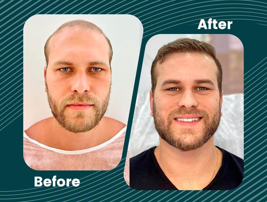 Turkey Hair Transplant Before and After