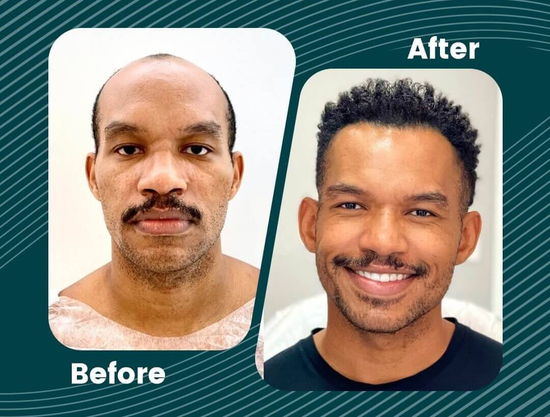 Turkey Hair Transplant Before and After