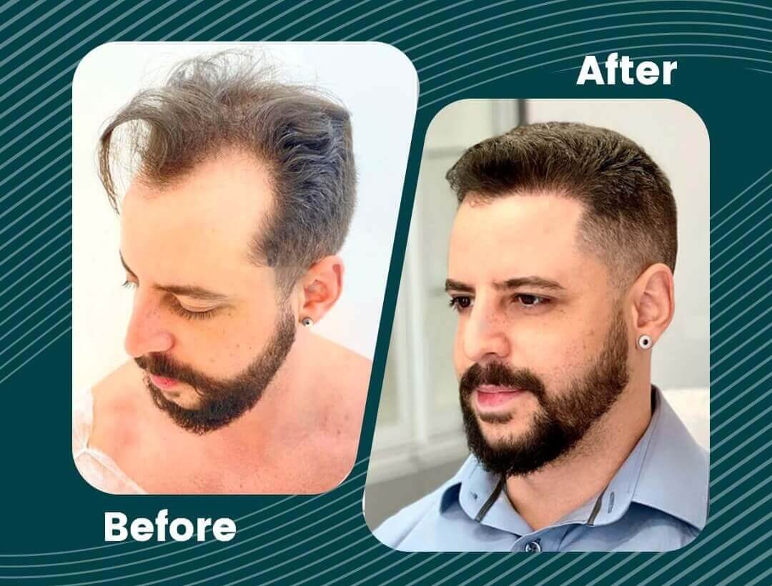 Turkey Hair Transplant Before and After