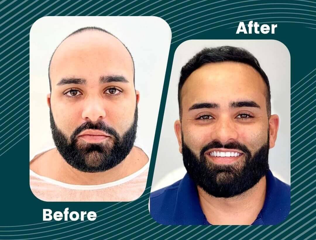 Turkey Hair Transplant Before and After