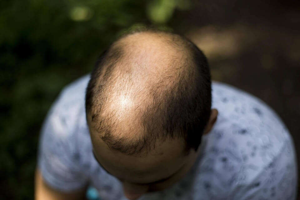 Male or Female Pattern Baldness: Causes, Differences, and Treatment Options