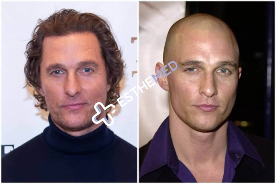 Matthew McConaughey Hair Transplant: Did He or Didn’t He?