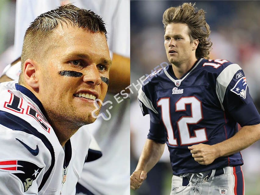 Tom Brady Hair Transplant