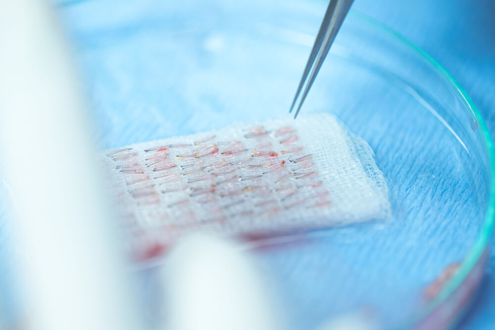 Understanding Hair Transplant Graft Numbers